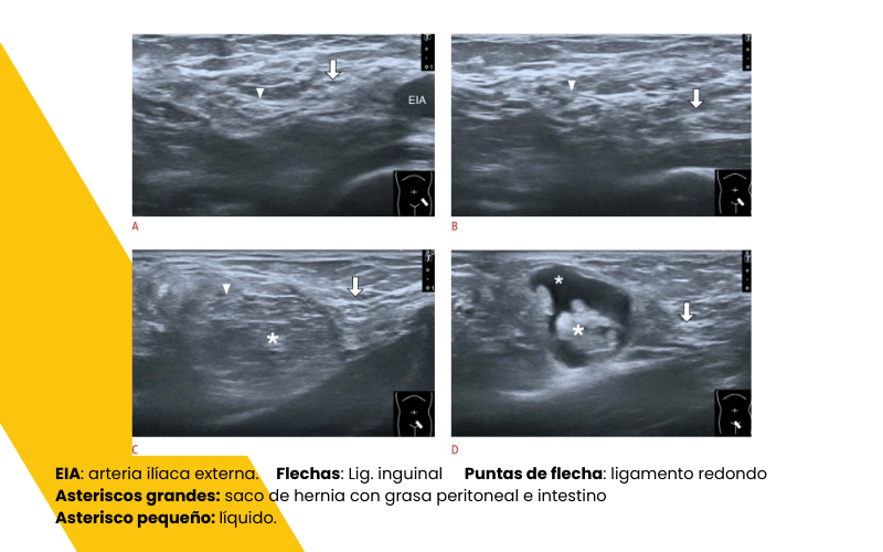 7. Hernia inguinal indirecta ecografia tempo formacion.png